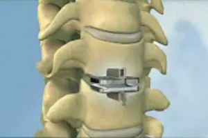 Synthes USA Vertebrae Replacement Implants