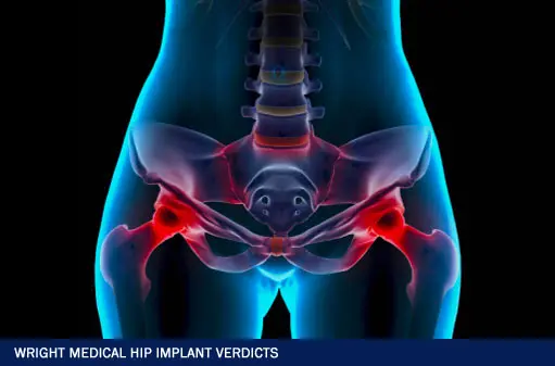 Wright Medical Hip Implant