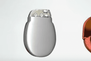 Implantable Defibrillator