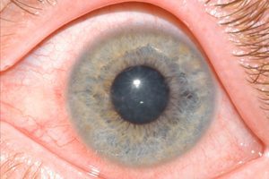 More Cases Of Eye Infection