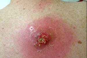 MRSA Skin Infections