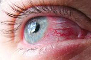 eye fungus infection