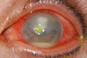 B&l Eye Infection