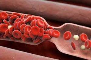 blood clots in Drug-Coated Stents