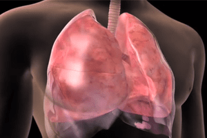 Lung Cancer Study