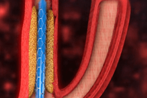NexStent Carotid Artery Stents