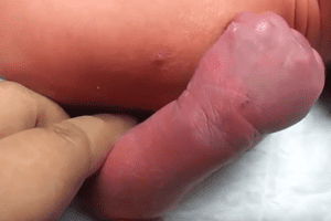 Dilantin Injection Purple Glove Syndrome