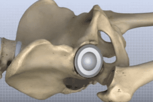 Lifespan And Success Of Artificial Hip, Knee Implants Unpredictable