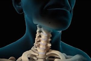 BMP Protein Products Linked to Complications in Neck Spine Surgery