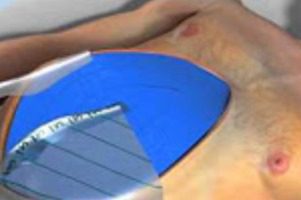 Negative Pressure Wound Therapy Warning From Fda