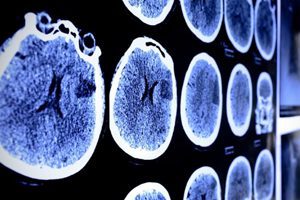 More Brain Tumors Reported In The Acreage