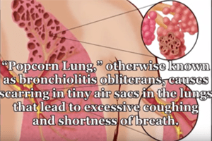 Popcorn Lung