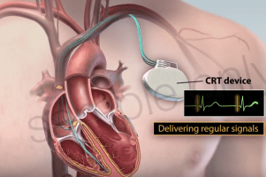Shareholders sue over boston scientific defibrillator recall