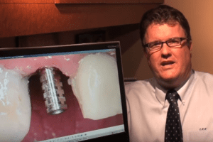 Dentist’s lawsuit claims nobeldirect dental implants are defective
