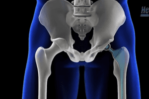 DePuy ASR Hip Implant Recall