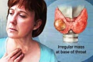 Thyroid Tumor