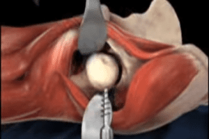 DePuy Pinnacle Hip Implant Complaints