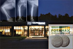 Pw Files Suit For Fosamax Femur Fracture Victims