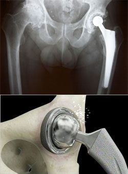First DePuy ASR Hip Implant Lawsuits Head to Trial in December, January