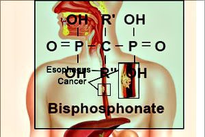 Bisphosphonate Studies Raise Esophageal Cancer Worries