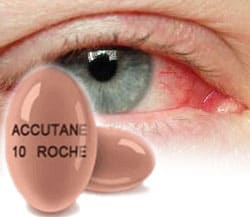 Accutane Associated with Double Risk of Eye Disorders