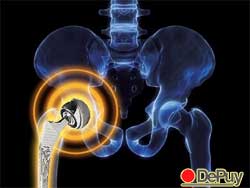 Federal DePuy ASR Hip Implant Trials Likely to Start This Year