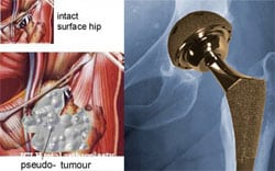 New Study Links Metal-on-Metal Hip Replacement Corrosion with Adverse Local Tissue Reactions