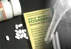 Lawsuit Alleges Woman Suffered Femur Fracture Due to Fosamax