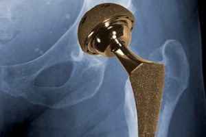 Metal On Metal Hip Implant