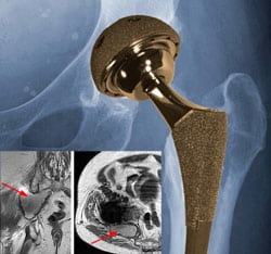 Study Finds Metal-on-Metal Hip Implants Associated with High Incidence of Pseudotumors