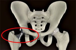 Metal Hip Implants
