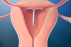 National law firm continues to investigate mirena iud cases