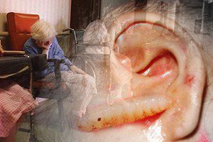 Scores of Maggots in Patient's Ear Prompts Lawsuit – Parker