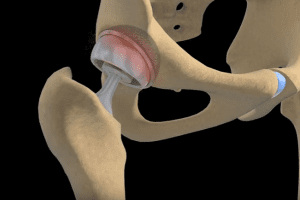 Depuy, j&j aware of 40 percent failure rate on its hip implant
