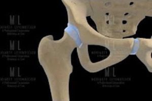 Depuy asr hip implant designer, surgeon would have blocked approval