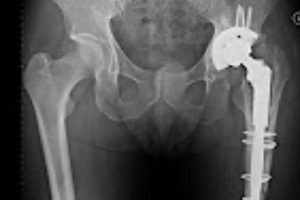 Johnson & johnson to pay $8.3 million in depuy asr defective hip judgment