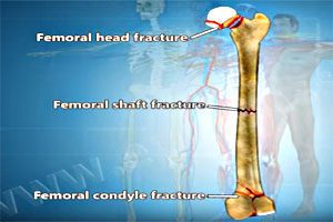 New Lawsuit Alleging Fosamax Causes Broken Bones