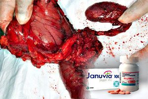 Link between januvia and pancreatic cancer