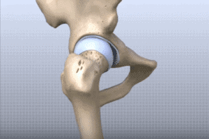 Joint Replacement Systems