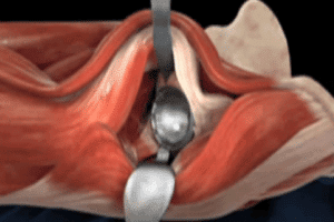 DePuy Pinnacle Hip Implant