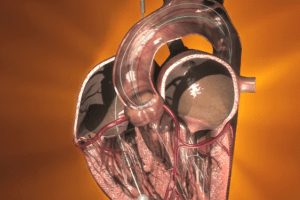 Recently approved medtronic heart valve device under class 1 recall
