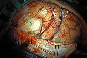 Tysabri brain infection risk