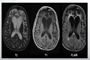 Dilantin linked to cerebellar atrophy