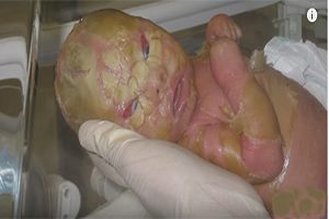 Woman alleges zofran caused shattering birth defects