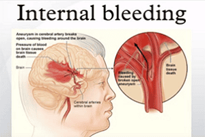  Internal Bleeding Blindness