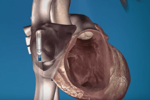 Fda recalls medtronic heart pump calling it life-threatening