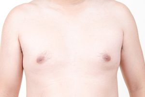 Fifth large risperdal gynecomastia settlement reached before trial