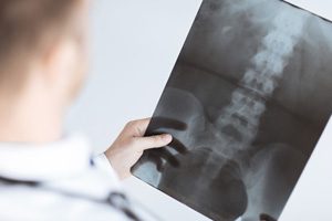 Metal hip implants cause painful injuries