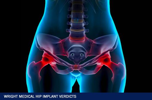 Wright Medical Hip Implant