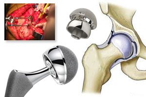 Hip Implant Revision Surgery